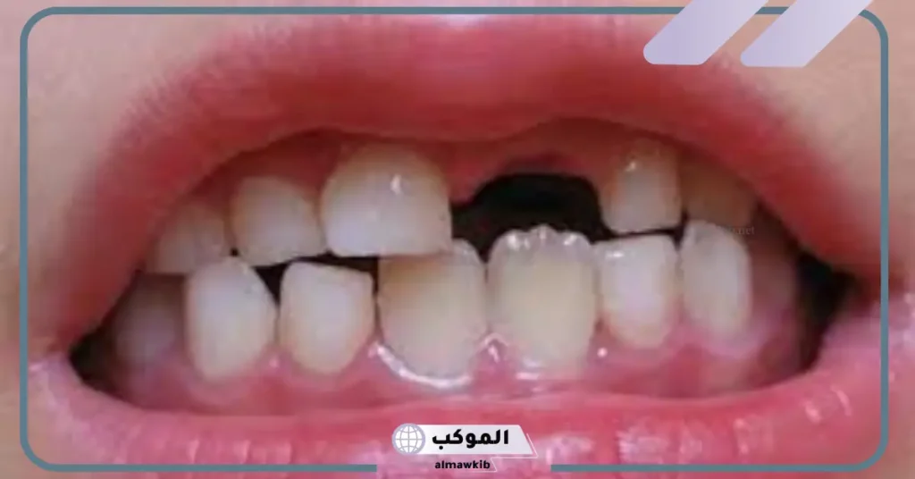 تفسير حلم كسر السن للمتزوجة