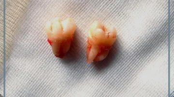 الضرس في المنام