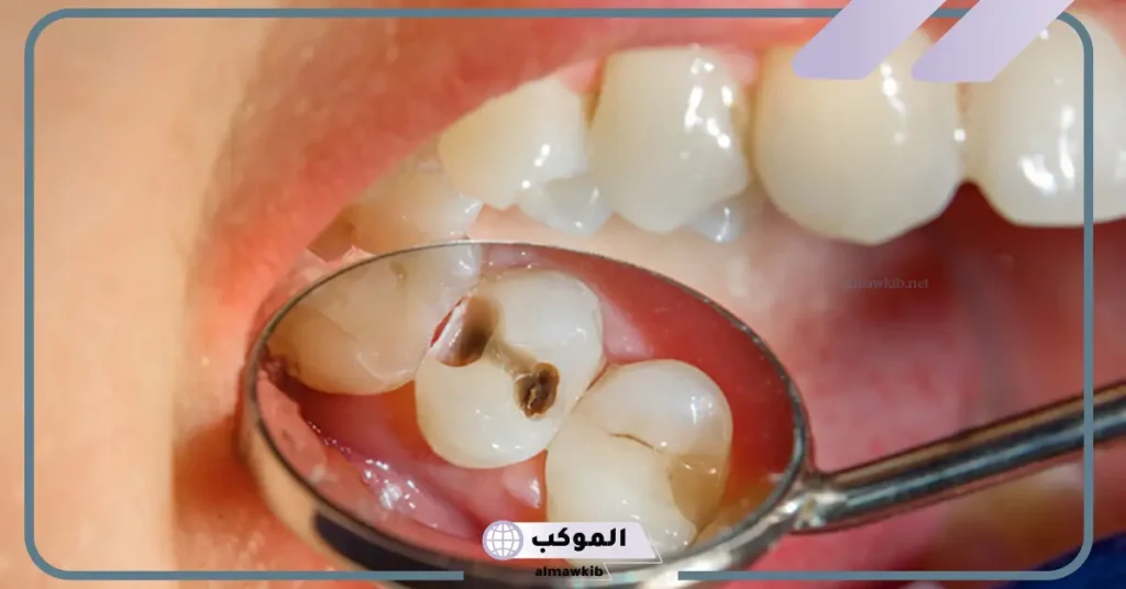 رؤية تسوس الأسنان في المنام للمتزوجة