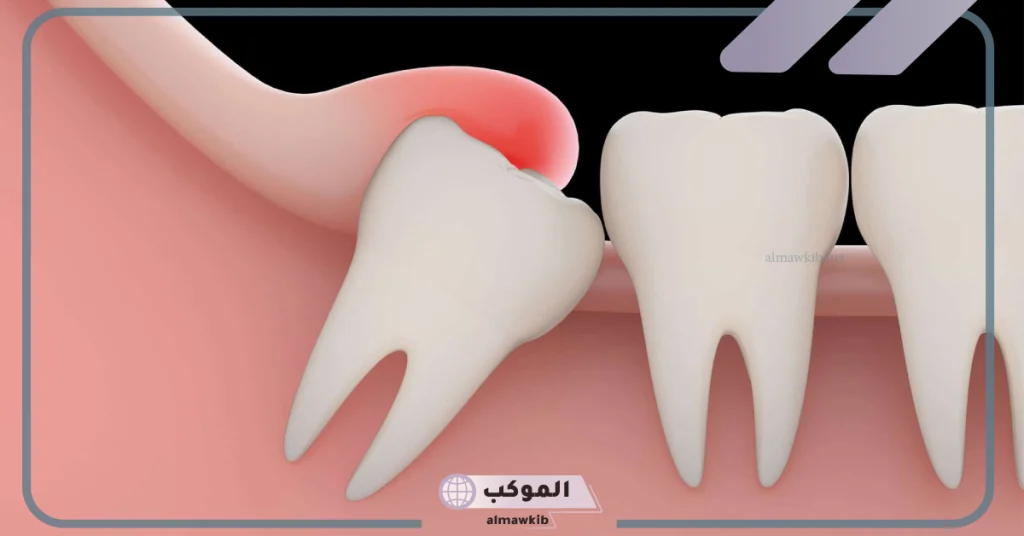 تفسير كسر الضرس في المنام للمتزوجة 