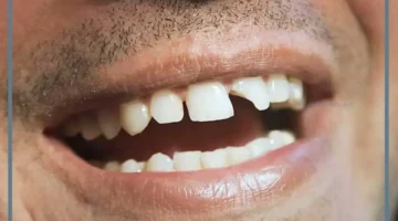 تكسير السن في المنام