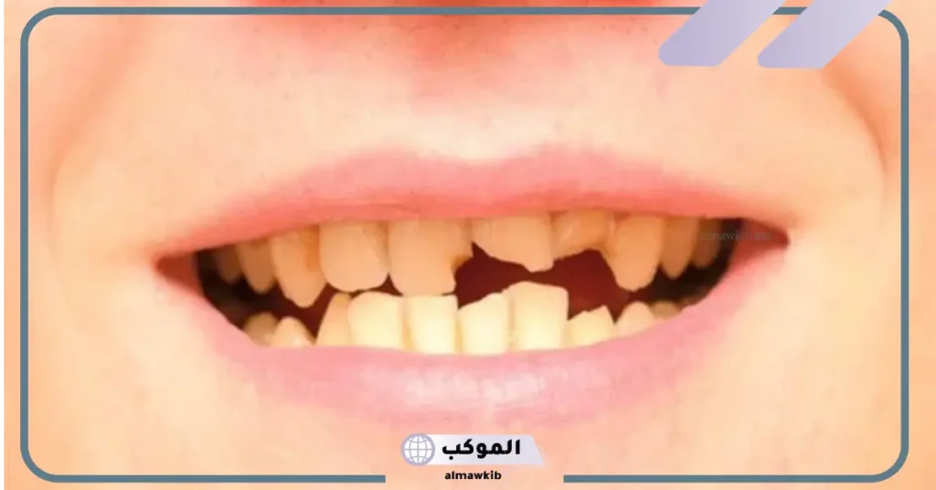 تفسير حلم تكسير الأسنان للعزباء