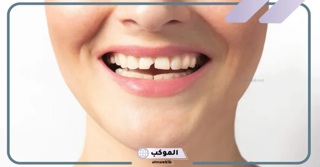 تفسير حلم تكسير الأسنان للعزباء