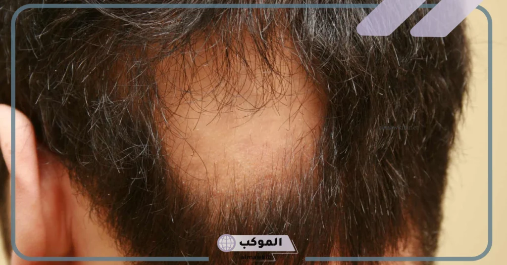 تفسير حلم الثعلبة للرجل 