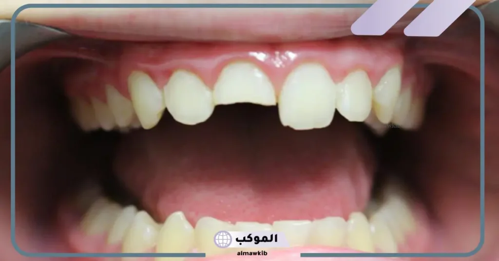 تفسير حلم كسر جزء من السن السفلي