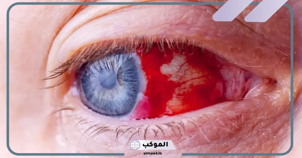 تفسير حلم فقدان عين واحدة في المنام وفقًا لابن سيرين 6 تفسير حلم فقدان عين واحدة للمتزوجة