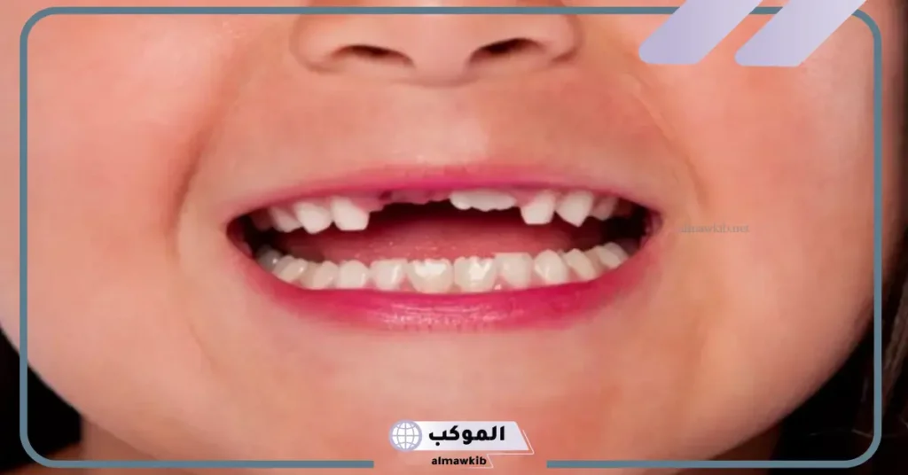 ما هو تفسير حلم تكسر الاسنان أو الضرس لابن سيرين في المنام 6 تفسير حلم كسر السن السفلي للمتزوجة