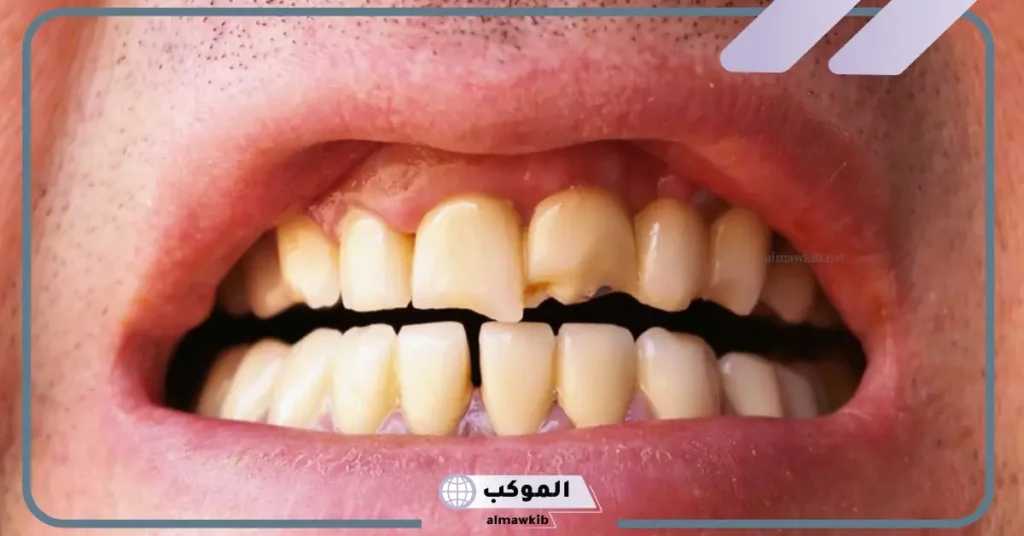 ما هو تفسير حلم تكسر الاسنان أو الضرس لابن سيرين في المنام 5 تفسير حلم تكسير الأسنان للعزباء