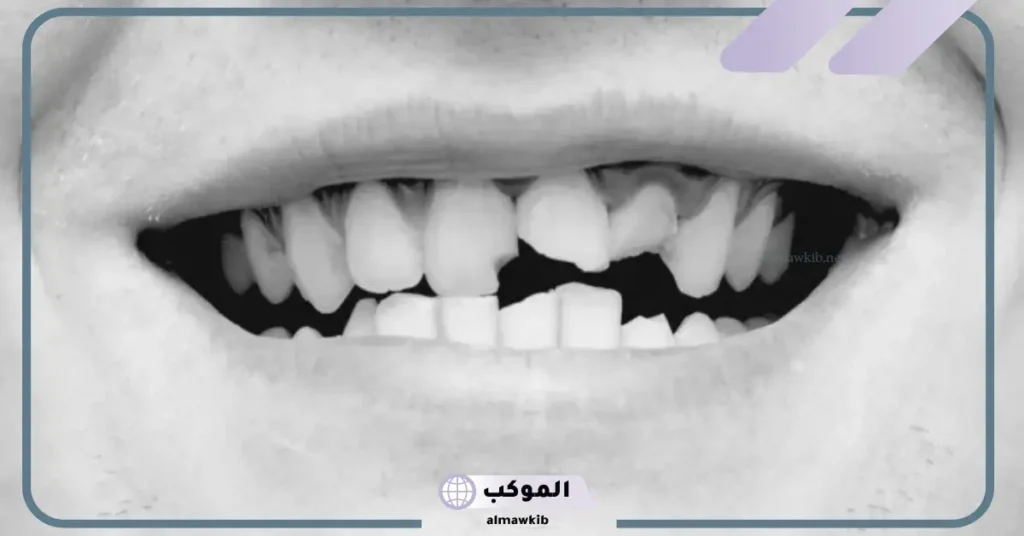 تفسير حلم تكسير الأسنان للعزباء