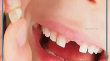 منام الأسنان