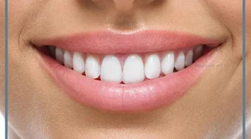 حلم الاسنان الامامية