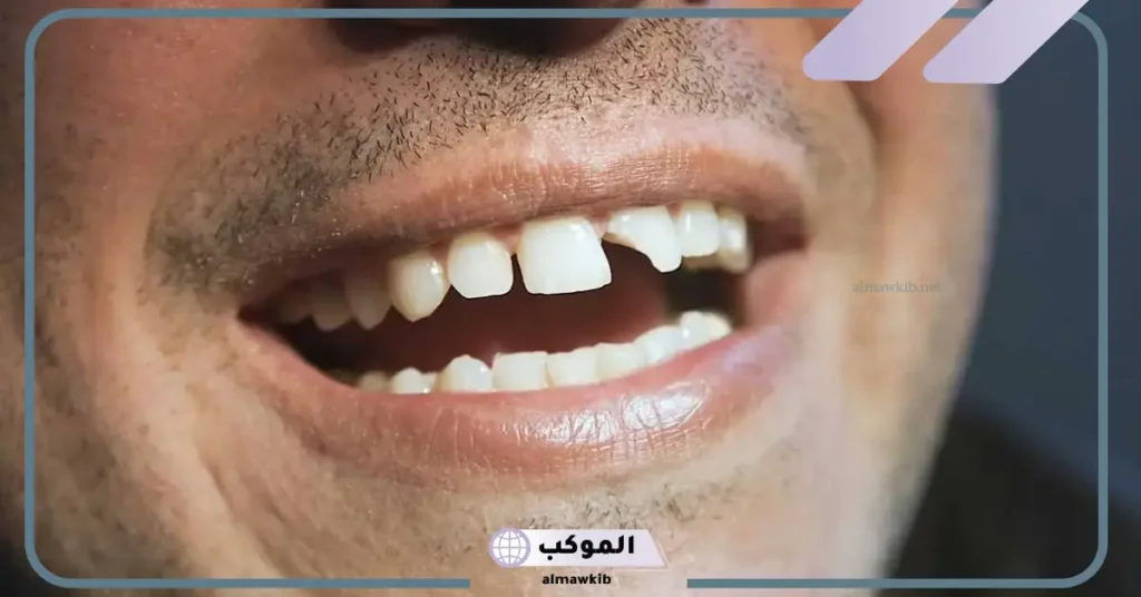 تفسير كسر السن في المنام للعزباء