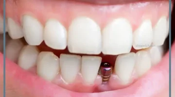 حلمت بتركيب الاسنان