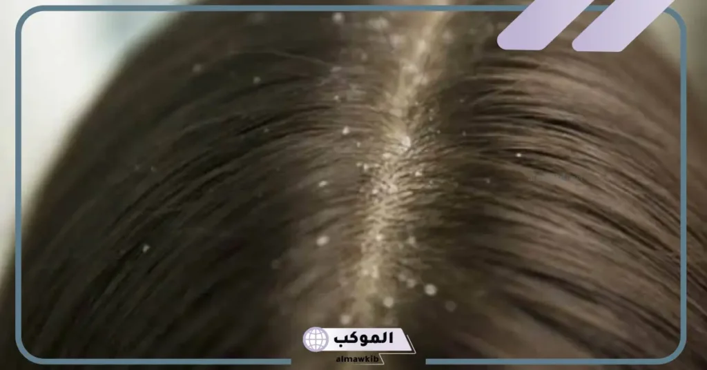 رؤية القمل في الشعر في المنام للمتزوجة