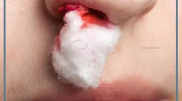 حلمت بالرعاف