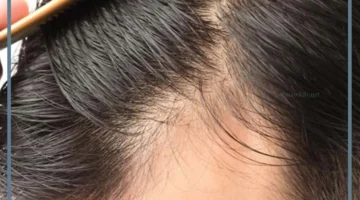 حلمت بالصلع