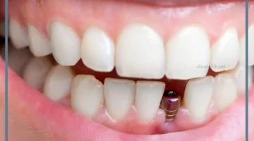 حلمت بسقوط الاسنان