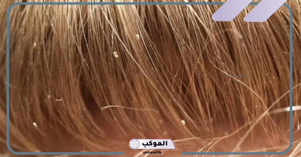 تفسير حلم القمل في الشعر للبنت