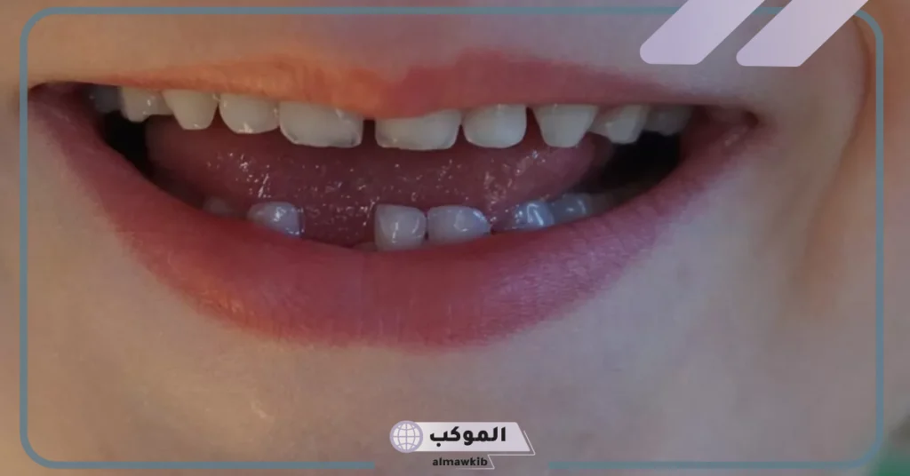 تفسير حلم سقوط سن واحد سفلي للعزباء 