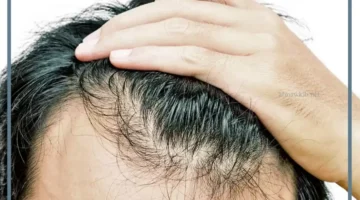 تفسير حلم تساقط الشعر والصلع من الإمام