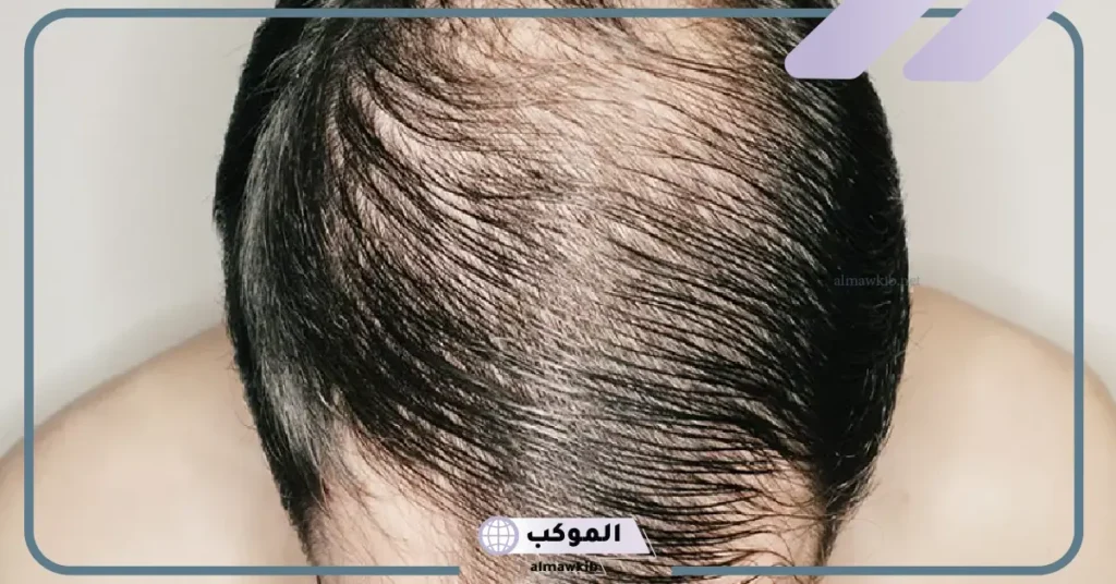 تفسير حلم تساقط الشعر خصل كبيرة