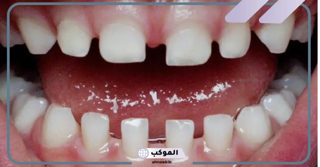 تفسير حلم فراغ بين الأسنان الأمامية للعزباء والمتزوجة في المنام 5 تفسير حلم فراغ بين الأسنان الأمامية للرجل