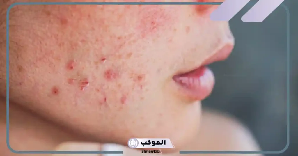 تفسير رؤية حبوب في وجه شخص اعرفه للعزباء