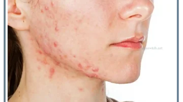 تفسير رؤية حبوب في وجه شخص اعرفه