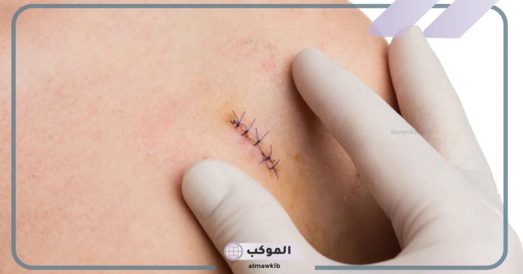 علاج تحجر البطن بعد العملية القيصرية 