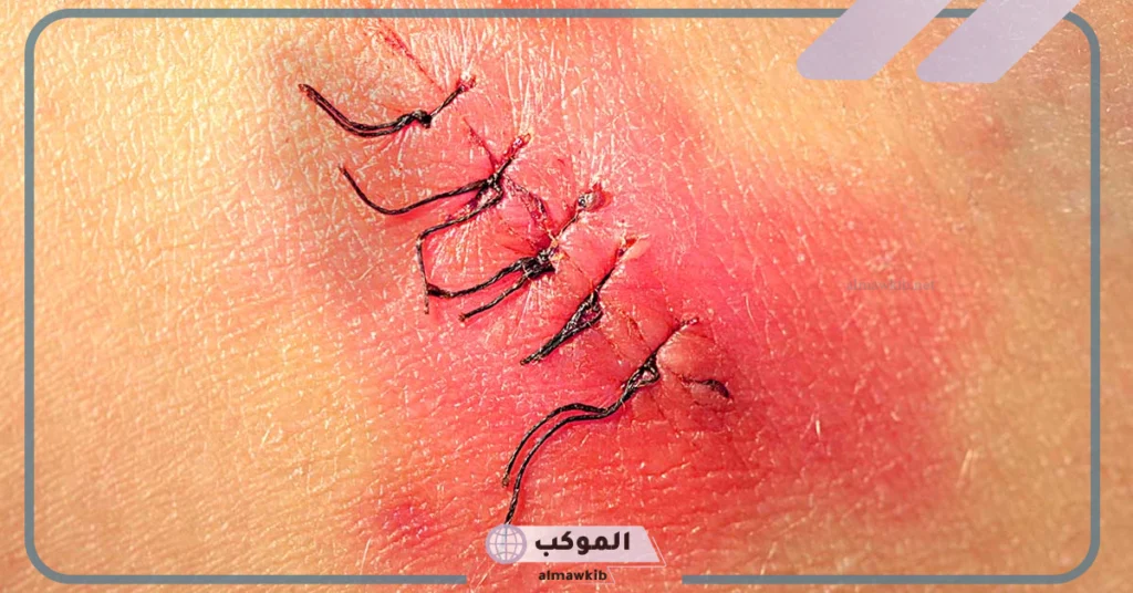 انتفاخ جرح العملية القيصرية من الداخل 