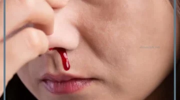 خروج الدم من الانف