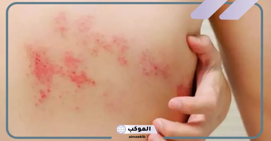 الحزام الناري والعلاقة الزوجية بالأسباب والعلاقة 5 أسرع طريقة لعلاج الحزام الناري