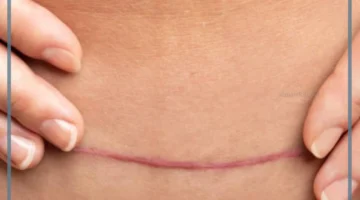 كتل جرح القيصرية