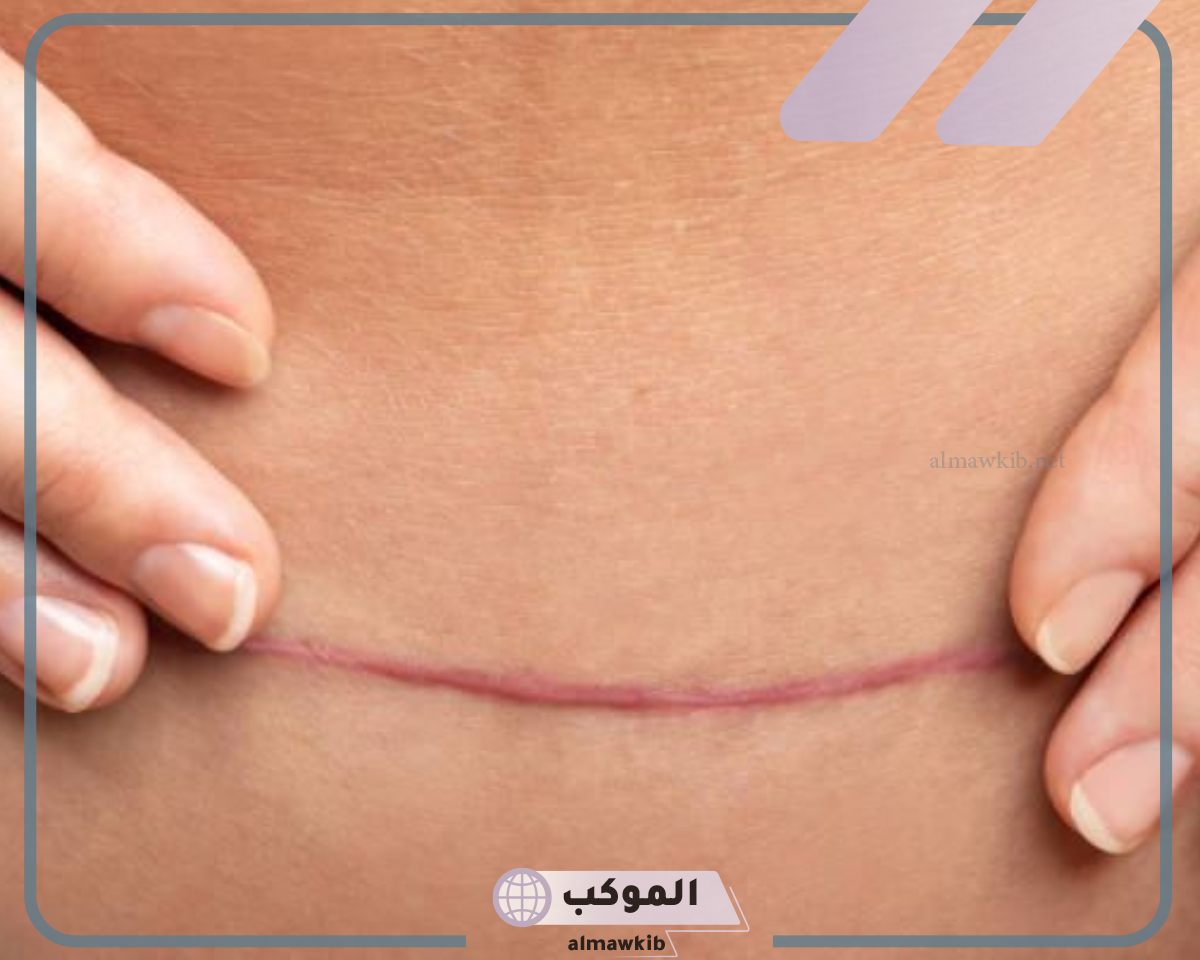 كتل فوق جرح القيصرية وعلاجها