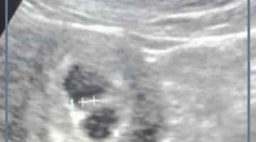 كيسين حمل واحد كبير والثاني صغير