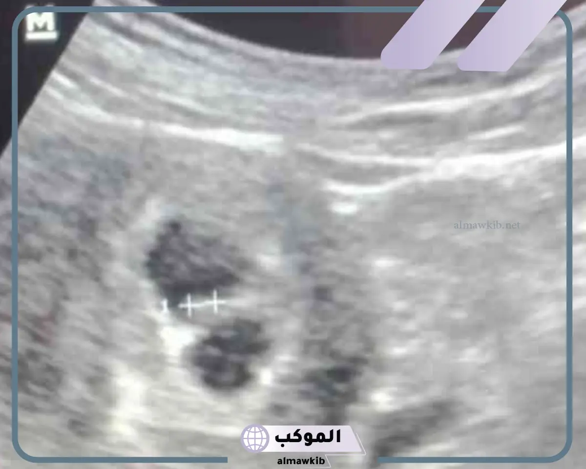 نوع التوأم في كيسين منفصلين