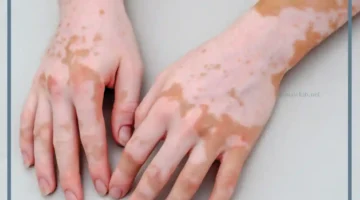 البهاق في المنام للطفل