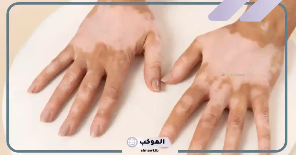 تفسير حلم البهاق في شخص أعرفه