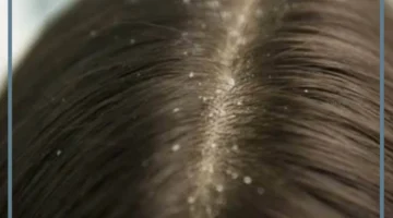 مشاهدة القمل