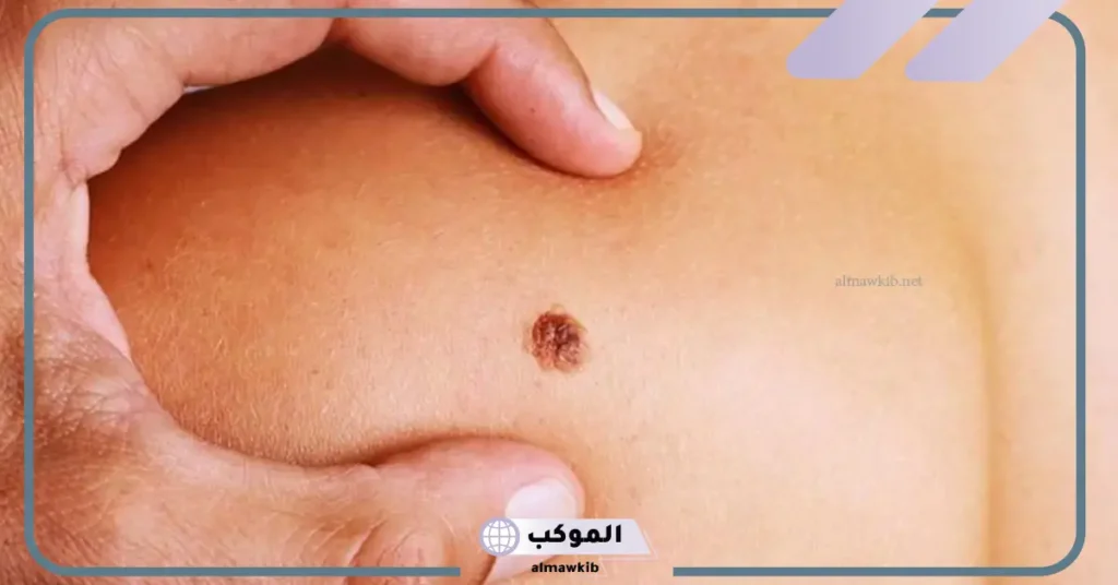 لقاحات سرطان عنق الرحم: كل ما تحتاجين لمعرفته حول الوقاية من فيروس الورم الحليمي البشري HPV 5 ورم حليمي فيروس