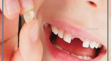 حلم سقوط اسناني