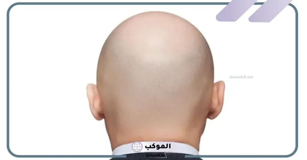 تفسير حلم الصلع في المنام للمتزوج والأعزب والمرأة لابن سيرين 6 الصلع في المنام للعزباء