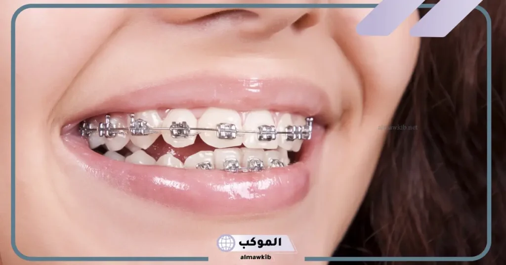 تفسير رؤية وضع تقويم الأسنان في المنام للعزباء