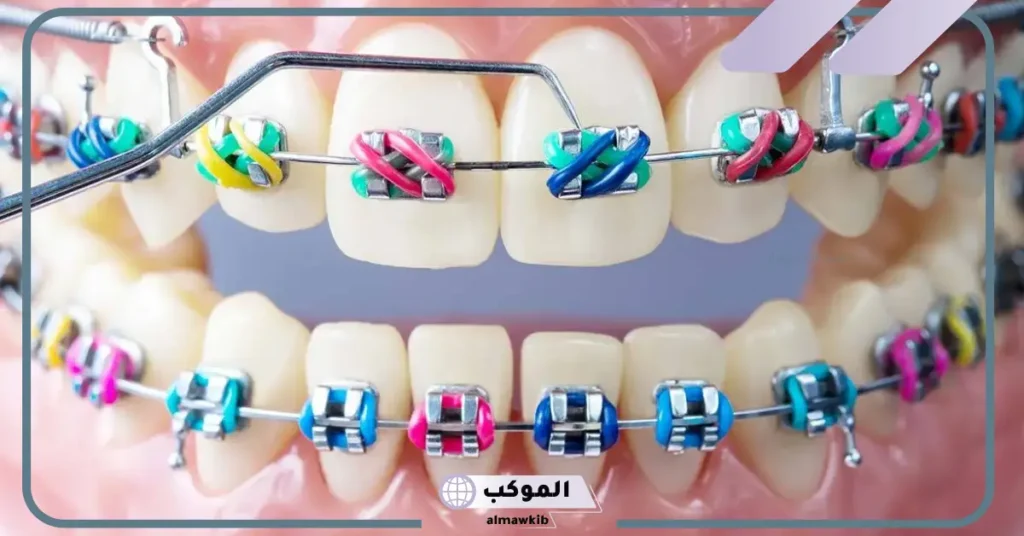 تقويم الأسنان في المنام للمتزوجة