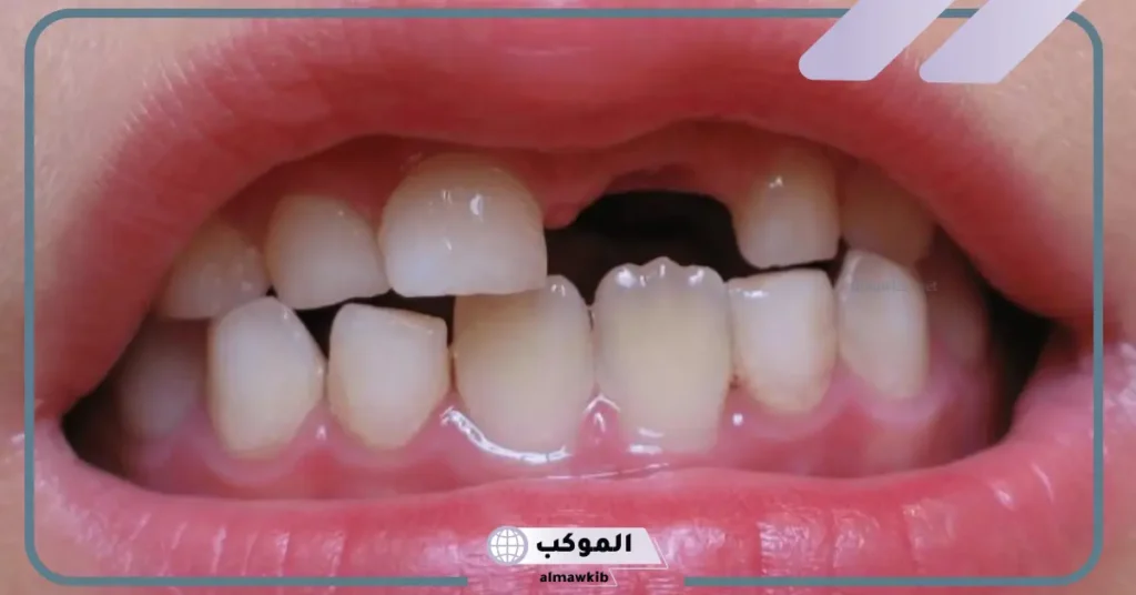 كسر السن في المنام للعزباء