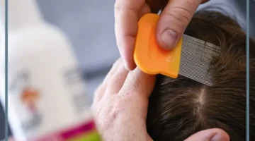 حلمت بالقمل