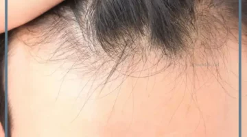 حلمت بسقوط الشعر