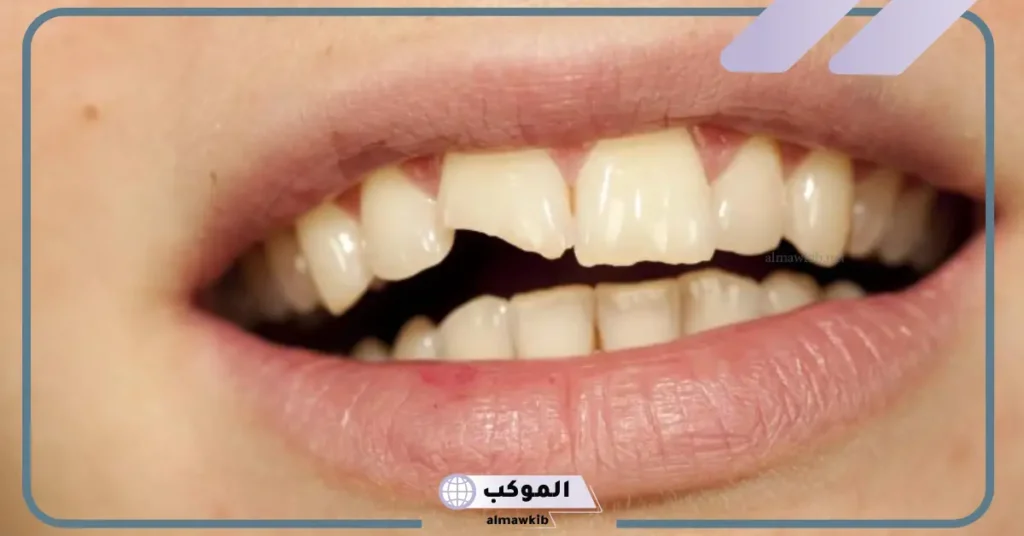 رؤية كسر السن في المنام للمتزوجة