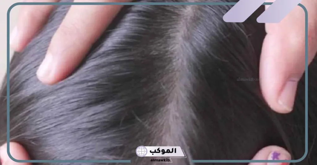 تفسير رؤية القمل في المنام للمرأة العزباء للعالم ابن سيرين 6 رؤية القمل في الشعر في المنام للمتزوجة