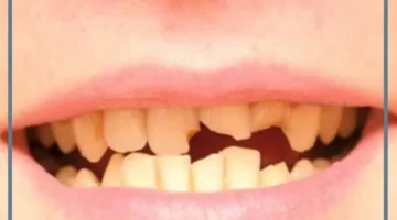 منام كسر سن